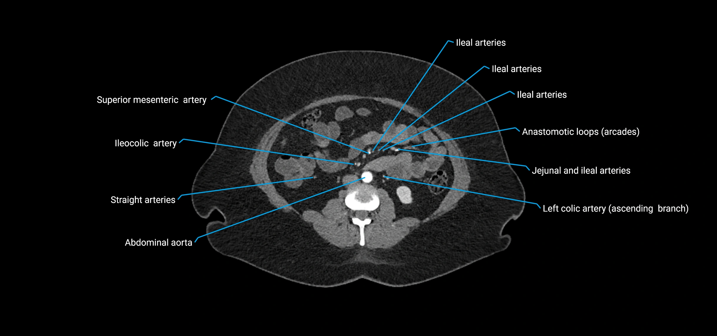 CTA abdomen axial cross sectional anatomy labelled image_102 (2).webp
